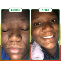 100g AFRICAN BLACK SOAP Shea Butter Bar Moisturizing Acne Treatment Cleanser for Clear Skin Care Deep Cleaning Glowing