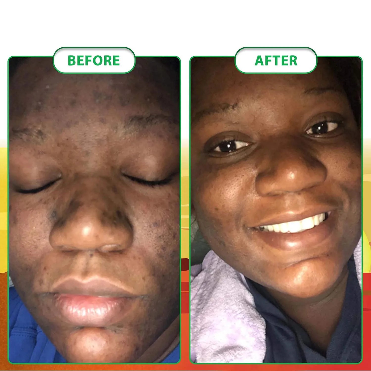 100g AFRICAN BLACK SOAP Shea Butter Bar Moisturizing Acne Treatment Cleanser for Clear Skin Care Deep Cleaning Glowing