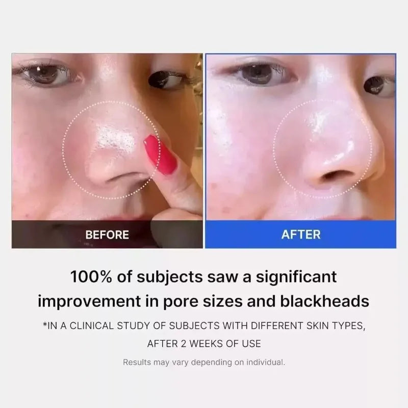 2025 New Popular Lactic Acid Face Cream Moisturizing Pores Delicate Blackhead Removing Day Cream Facial Care